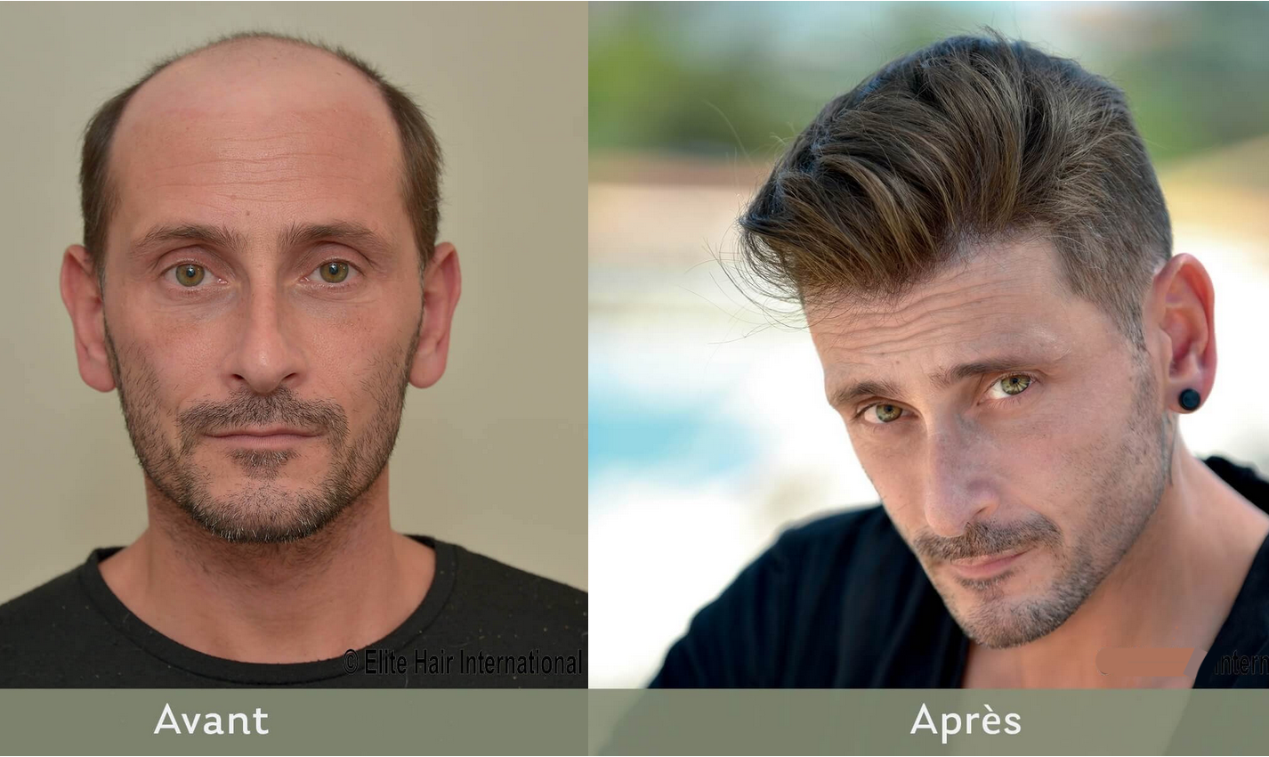 COMPLÉMENTS CAPILLAIRES MON ALOPÉCIE